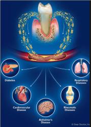 Oral and whole body health image of tooth decay, brain, lungs, bone joints